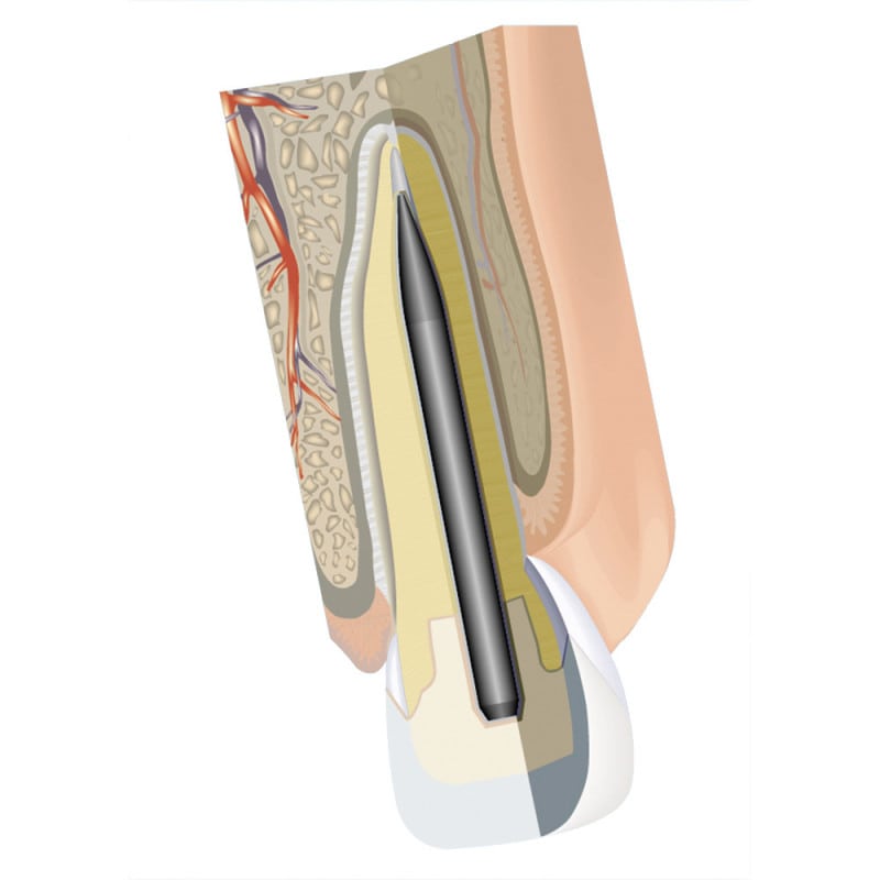 Mirafit Root Canal Anchors White Kit
