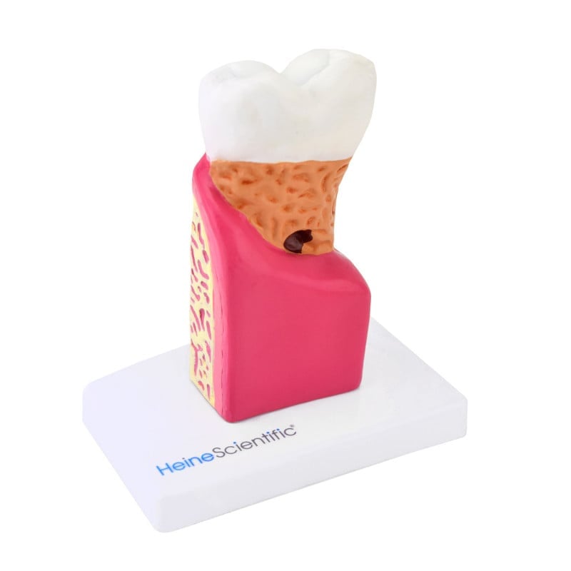 Tooth Model with diseases