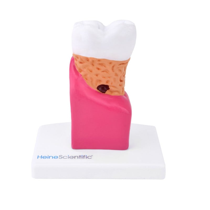 Tooth Model with diseases
