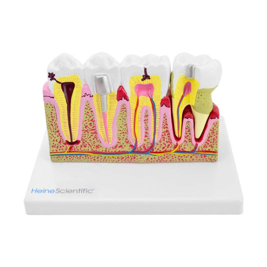 Dental Model with Diseases
