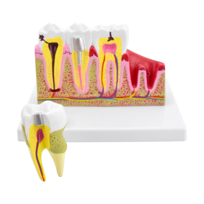 Dental Model with Diseases