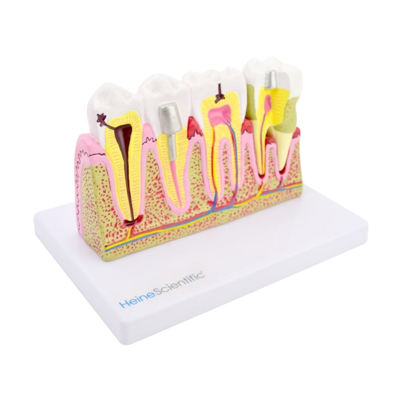 Dental Model with Diseases